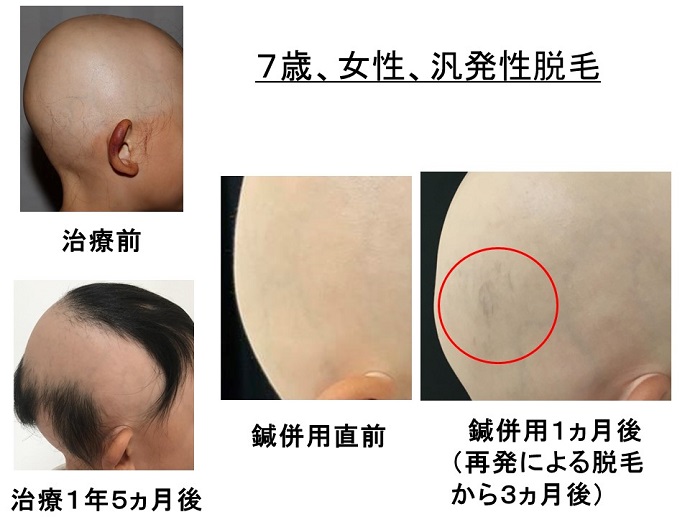 円形脱毛症　病院